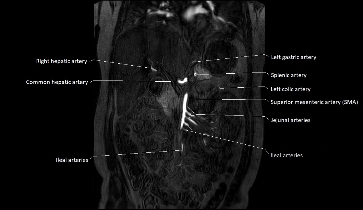 MRA Abdomen coronal anatomy image 7.webp